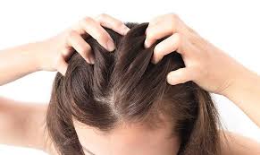 Jerawat di Kepala, 4 bahan alami ini dapat menyembuhkannya