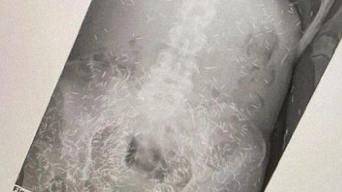 Viral Penampakan Susuk, Dokter Radiologi Jelaskan Fenomena Corpus Alienum